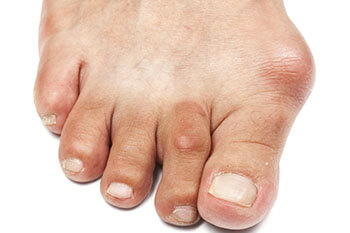 bunions treatment in in the Miami, Pembroke Pines, Miami Gardens, Hollywood, Hallandale Beach, Davie, Dania Beach, North Miami, Hialeah, Fort Lauderdale areas