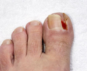 Ingrown toenails treatment in the Miami, Pembroke Pines, Miami Gardens, Hollywood, Hallandale Beach, Davie, Dania Beach, North Miami, Hialeah, Fort Lauderdale areas